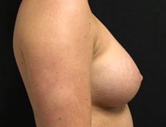 Breast Aug, Side, Post Surgery