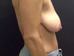 Breast Lift Full, side, before