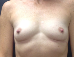 Front view, before breast augmentation: 34A
