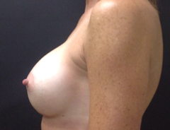 Side View, Breast Augmenation, After: 34C Full