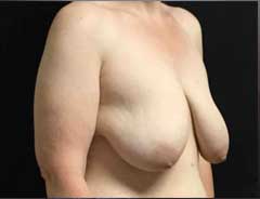 Before Breast Lift diagnal