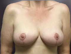 After Breast Lift front
