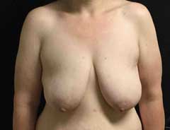Before Breast Lift front