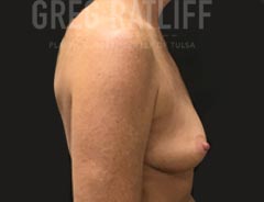 Breast Aug - Side View - Before Surgery