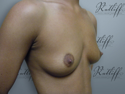 Half Profile before breast augmentation: 34B