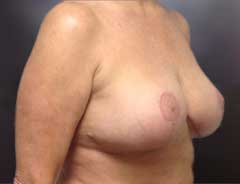 after breast lift diagnol