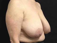 Before Breast Lift diagnal