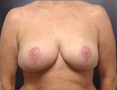 After Breast Lift front