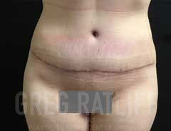 full tummy tuck - front - after