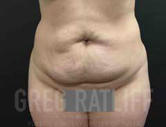 full tummy tuck - front - before
