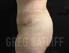 full tummy tuck - side - after