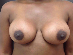 Front view, after breast augmentation: 36D Full