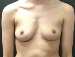 Front view, breast augmentation, before