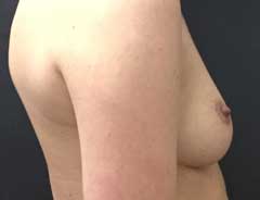 Side view, breast augmentation, before