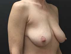 Before Breast Lift diagonal