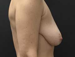 Before Breast Lift side