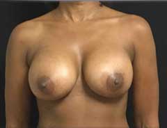Front view, breast augmentation, after