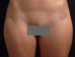 After Liposuction front