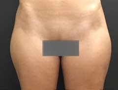 Before Liposcution front