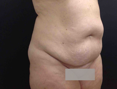 Angle view, full tummy tuck, before
