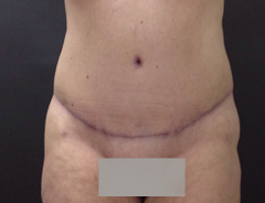 Full Tummy tuck after front
