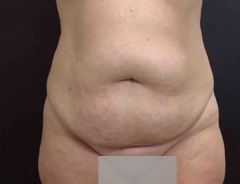 Full Tummy tuck before front