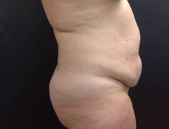 Side view, full tummy tuck, before