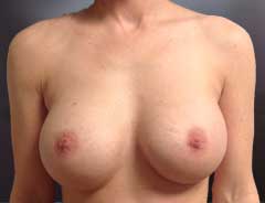 Front View, Breast Augmenation, after