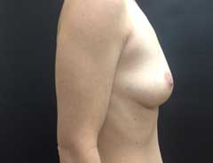 Side view, breast augmentation, before