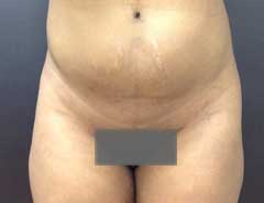 Before Liposuction front