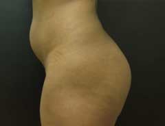 Before Liposuction side