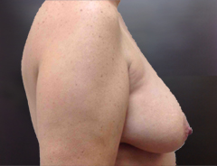 Side View, Breast Augmenation & Lift, Before: 36D