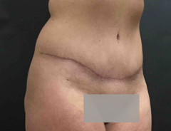 Angle view, full tummy tuck, after