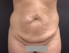 front view, full tummy tuck, before