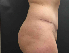 Side view, full tummy tuck, after