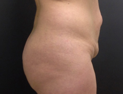 Side view, full tummy tuck, before