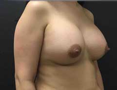 Angle view, breast augmentation, after