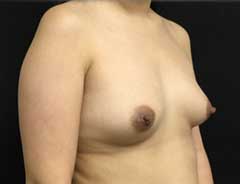 Angle view, breast augmentation, before