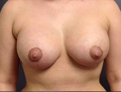 Front view, after breast aug & lift: 36D Full