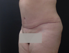 Angle View, extended tummy tuck, after