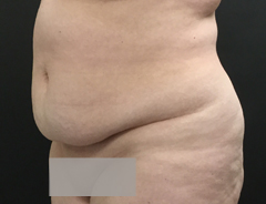 Angle View, extended tummy tuck, before