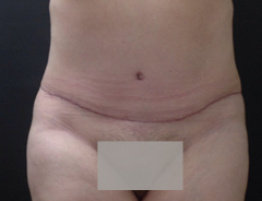 Front View, extended tummy tuck, after