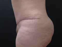 Side View, extended tummy tuck, after