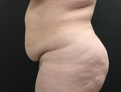 Side View, extended tummy tuck, before