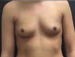 Front View, Breast Augmenation, before