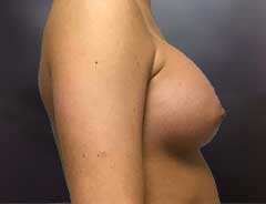 Side view, breast augmentation, after