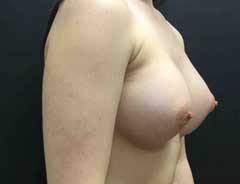 Angle view, breast augmentation, after