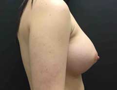 Side view, breast augmentation, after