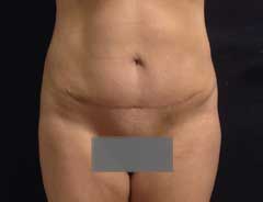 After Mini Tummy Tuck Front