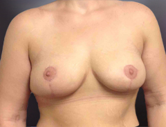 Front Extended Breast Lift, After